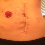 ileostomy stoma and scars on abdomen