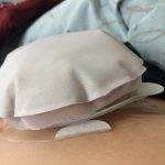 ostomy bag inflated from gas