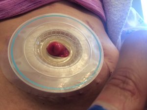 ostomy stoma with a barrier 