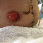 new ileostomy and a stapled stomach