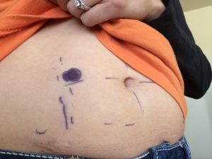 stomach marked for an ileostomy