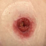 end colostomy stoma with irritation